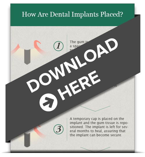Dental implants Danbury CT free digital download.
